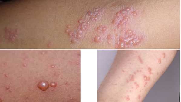 vaiolo herpes zoster